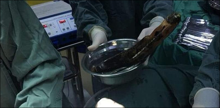 ڈاکٹروں نے پیٹ میں پھنسا ایک فٹ کا بینگن آپریشن کرکے نکال لیا