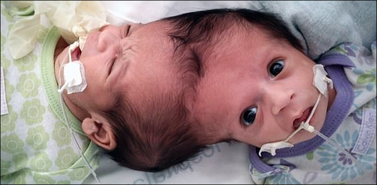 برازیلین جڑواں بہنوں کے سر کو کامیاب آپریشن کے بعد علیحدہ کردیا گیا