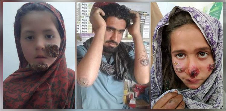 وزارت صحت کو لشمینیا کی دواؤں کے لیے جنیوا میں عالمی ادارے سے رابطے کی ہدایت