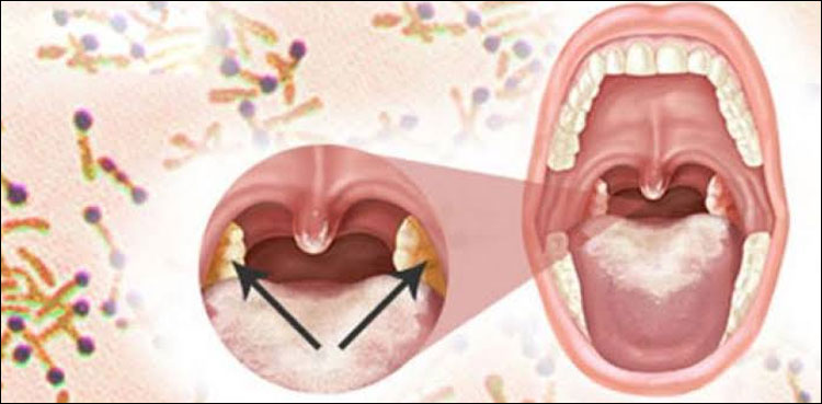 سندھ میں ایک اور وبا، ڈپتھیریا سے 15 بچے جاں بحق