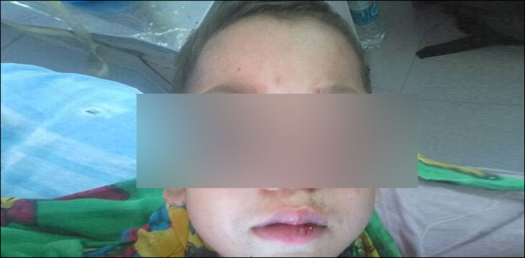 کینسر کا شکار بچے کی آنکھیں حلقوں سے باہر نکل آئیں