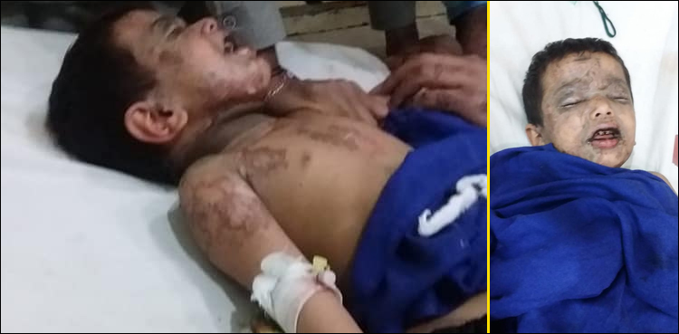 سفاک نامعلوم افراد نے 5 سالہ معصوم بچے پر تیزاب پھینک دیا