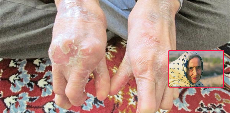 ماں‌ ہم بھی کوڑھیوں‌ کو تنہا نہیں‌ چھوڑیں‌ گے!