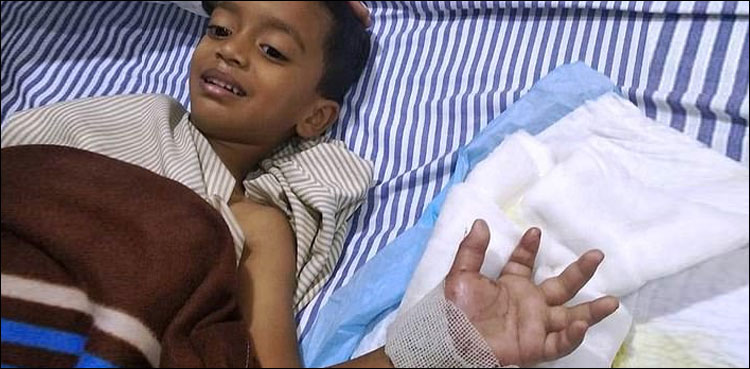ڈاکٹرز کا کارنامہ، بچے کا جسم سے کٹا ہوا ہاتھ دوبارہ جوڑ دیا