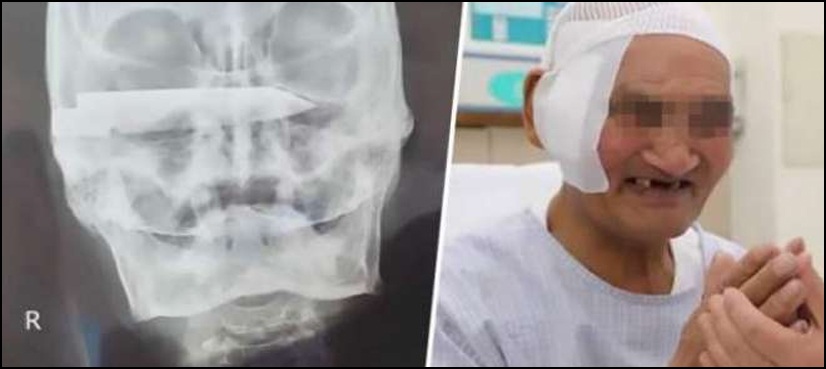 76سالہ شخص کی کھوپڑی سے 26 سال پرانا زنگ آلود بلیڈ نکال لیا گیا