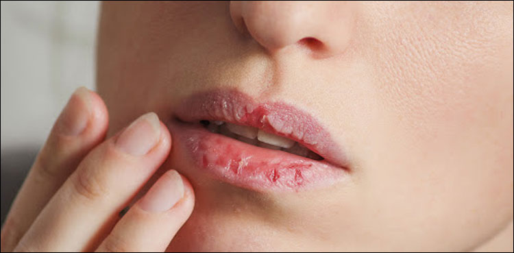موسم سرما میں خشک ہونٹوں سے کیسے نجات پائی جائے؟
