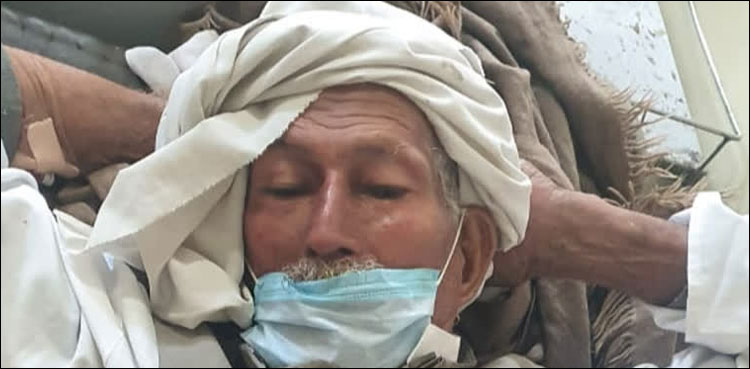 بھارت: 80 سالہ بزرگ کے پیٹ سے 2 ہزار سے زائد پتھریاں نکال لی گئیں