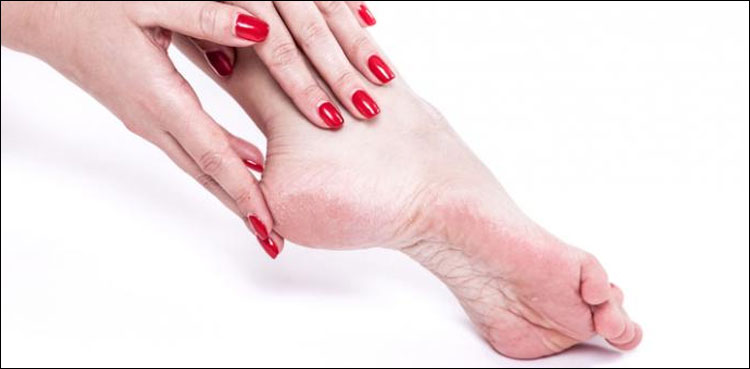 موسم سرما میں پھٹی ایڑھیوں کا علاج