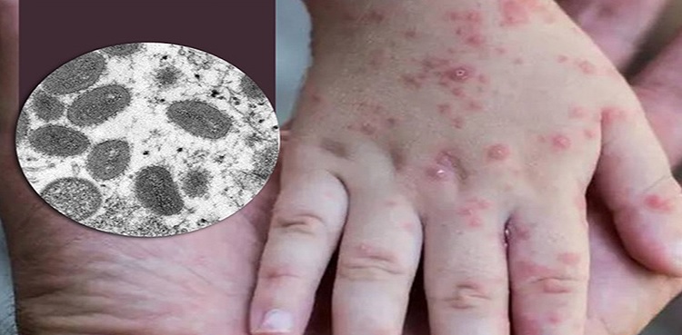 منکی پاکس کی  ایک انسان سے دوسرے انسان میں منتقلی، حکام نے کیا بتایا؟