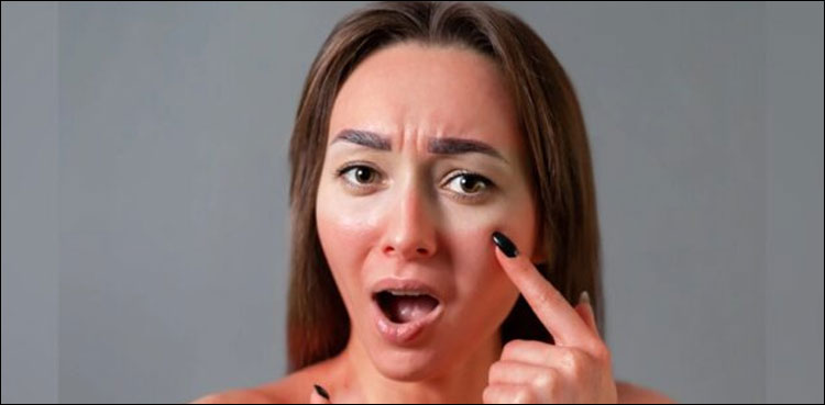 دھوپ میں جھلس جانے والی جلد کی تکلیف کیسے کم ہوگی؟