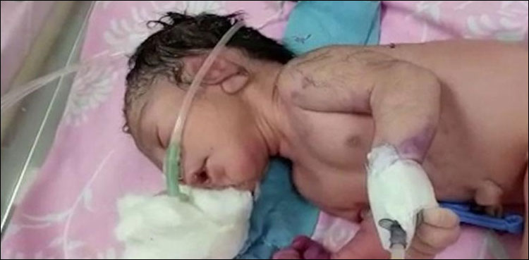 ٹانگوں‌ کی جگہ سینگ کے ساتھ پیدا ہونے والا بچہ دیکھ کر ڈاکٹر حیران