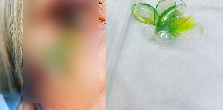 خاتون کی آنکھ سے 23 کانٹیکٹ لینسز نکل آئے