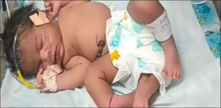 خاتون کے ہاں 4 ٹانگوں والی بیٹی کی پیدائش، اسپتال کا عملہ حیران