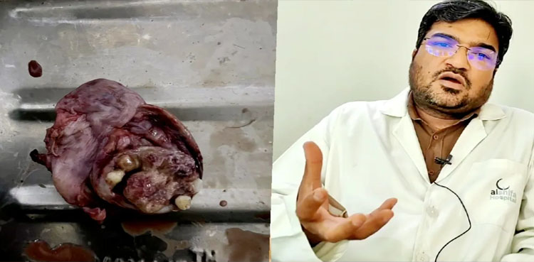 پیٹ کے اندر گانٹھ میں انسانی دانت، ڈاکٹرز بھی حیران