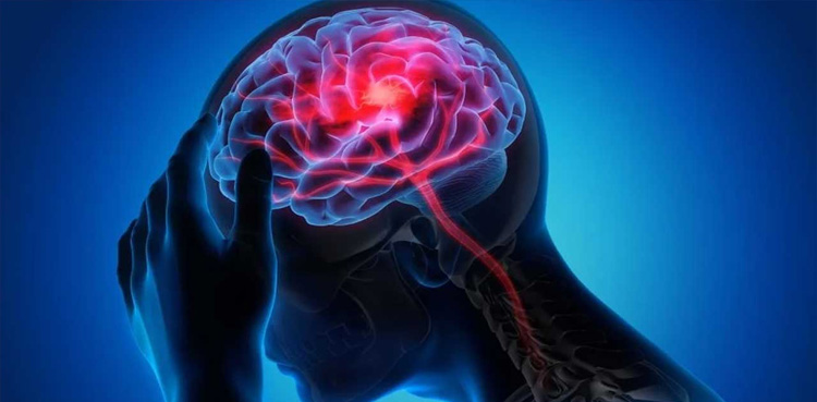 برین ٹیومر کیسے ہوتا ہے؟ علامات اور علاج