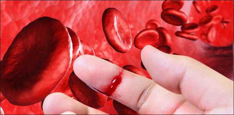 خون بہنے کی بیماری، کراچی میں پہلا ہیموفیلیا سینٹر قائم