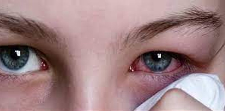 آشوب چشم کی وجوہات، بچاؤ کیسے ممکن ہے؟