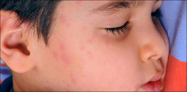 سکھر کے نواحی علاقے میں خسرے سے 10 دن میں 5 بچے جاں بحق