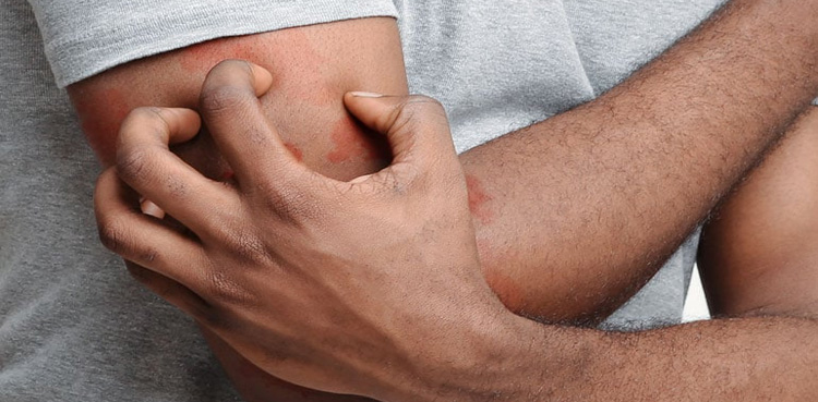خارش سے بچاؤ اور اس کا آسان علاج