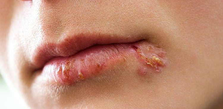 بخار کے بعد ہونٹوں پر چھالے کیوں نکلتے ہیں؟