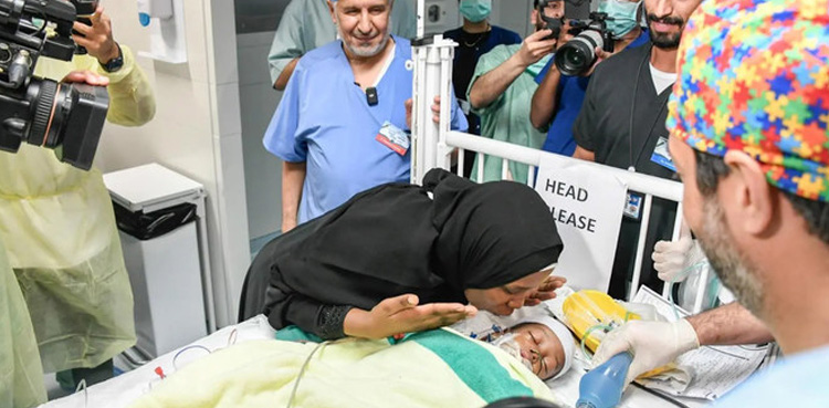 سعودی ڈاکٹرز کا کامیاب آپریشن، جڑواں بچوں کو علیحدہ کردیا