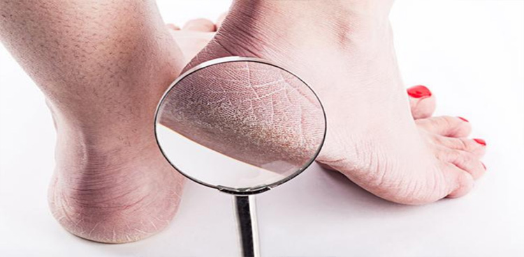 ایڑیاں پھٹنے کا علاج صرف ایک سبزی سے، جانیے کیسے؟