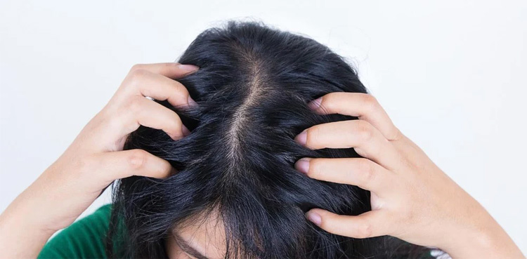 سر میں خارش کی وجہ خشکی نہیں ہوتی؟ تحقیق