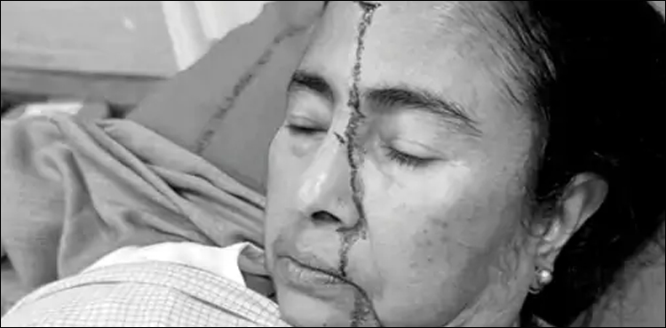 ممتا بینرجی گر کر شدید زخمی ہو گئیں