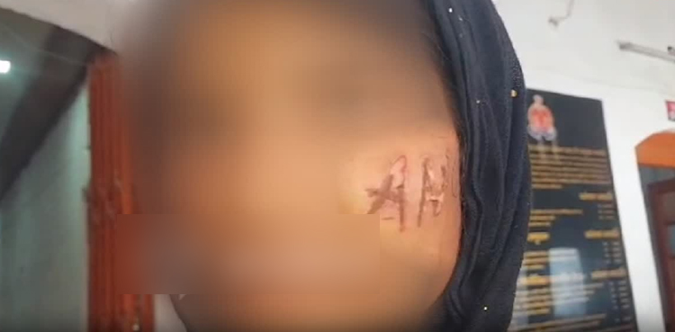 شادی سے انکار پر ملزم نے لڑکی کے چہرے پر گرم لوہے سے اپنا نام لکھ دیا