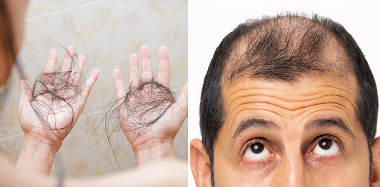 بالوں کو گرنے سے کیسے بچائیں؟ مرد و خواتین کا بڑا مسئلہ حل