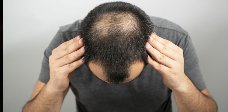 گنج پن کا خاتمہ اب اور بھی آسان، حیران کن تحقیق