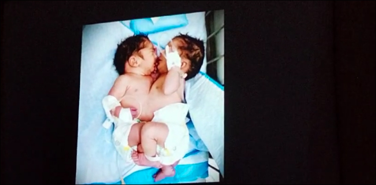 دھڑ سے جڑی بہنیں نائلہ اور شمائلہ کے حوالے سے اہم خبر