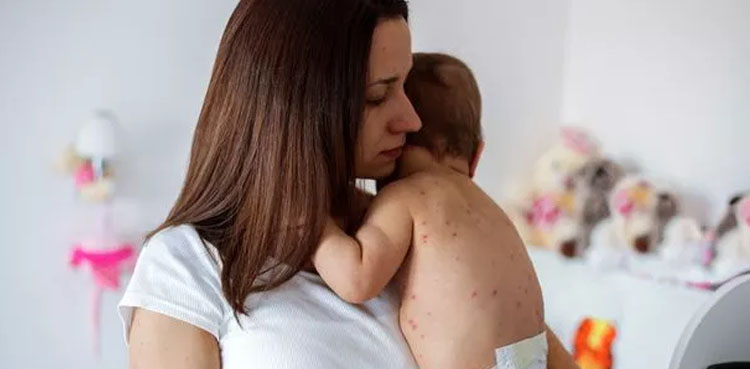 ٹیکساس میں خسرہ کی وباء پھیل گئی