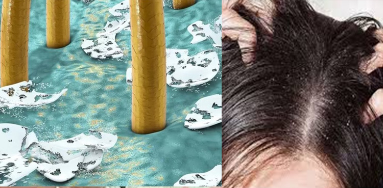 بالوں سے خشکی کیوں نہیں جاتی؟ اصل وجہ سامنے آگئی