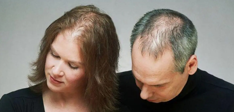 کتنے فیصد پاکستانی گنج پن میں مبتلا، مرد اور خواتین میں کون زیادہ شکار؟