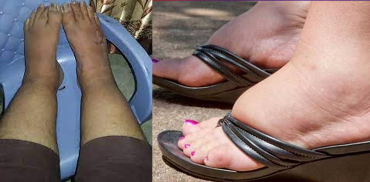 پیروں میں سوجن : کھڑے ہوکر کام کرنے والے افراد کیلیے اہم خبر