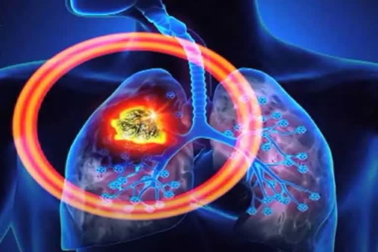 پھیپھڑوں کا کینسر :  یہ موذی مرض اپنی علامات کب ظاہر کرتا ہے؟