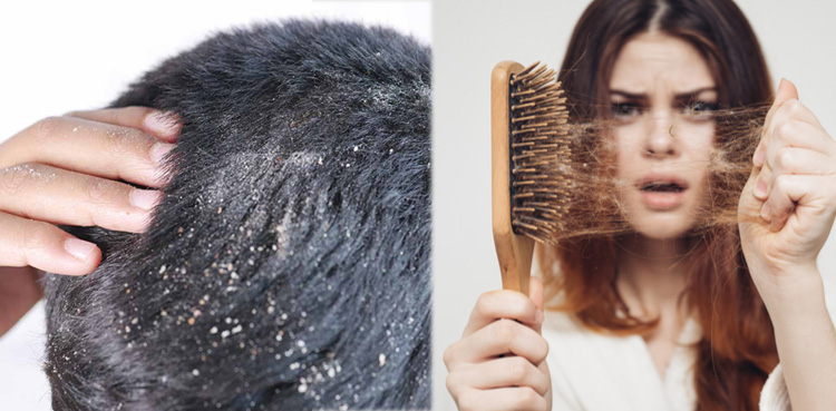 بالوں میں خشکی اور ان کا گرنا صرف 3 دن میں ختم، لیکن کیسے؟